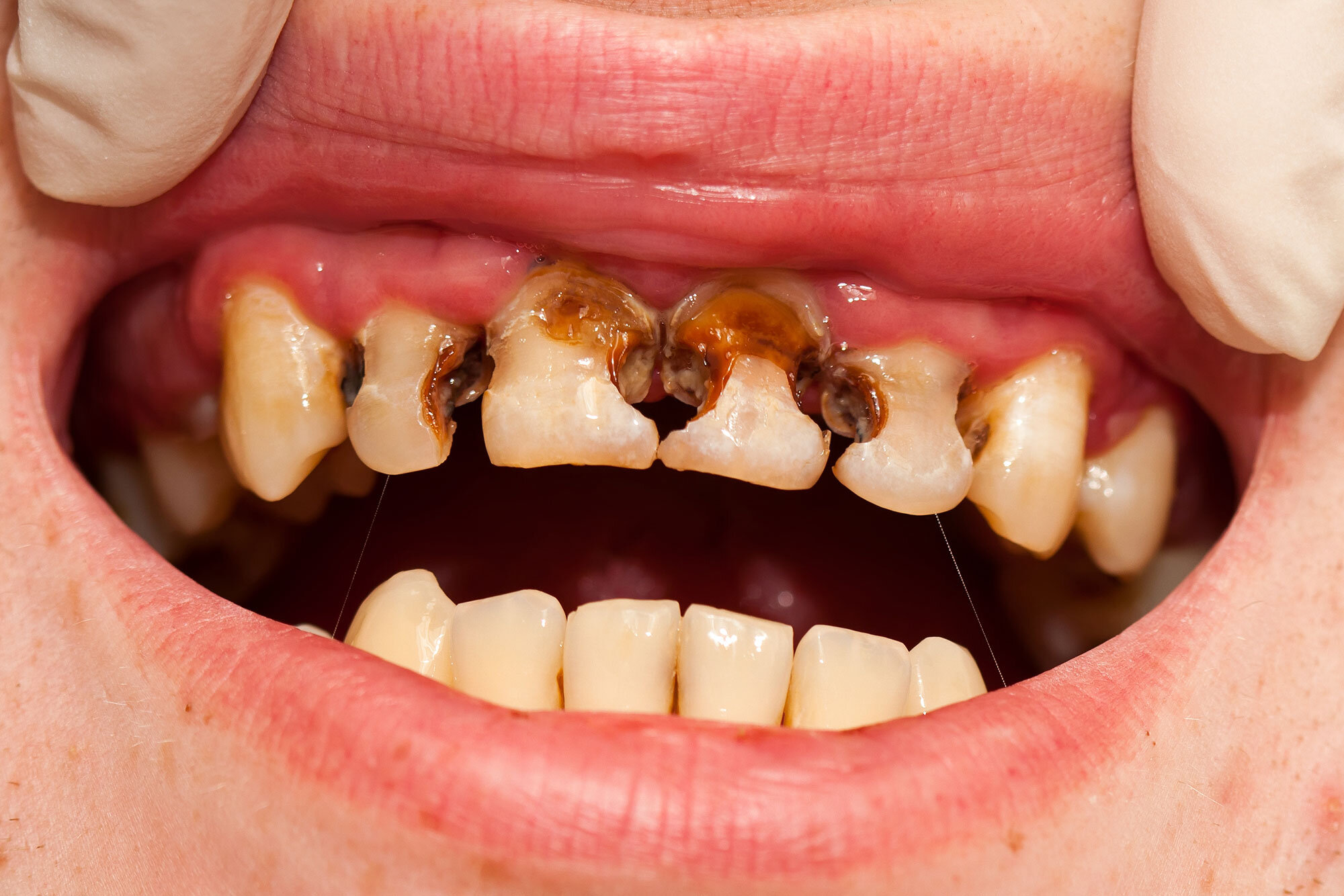 Prevent Tooth Decay